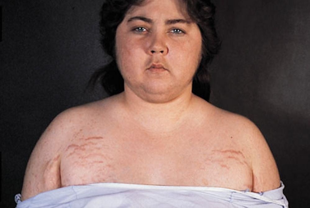 kušingo sindromas svorio kritimas numesti svorio cincy atsiliepimai