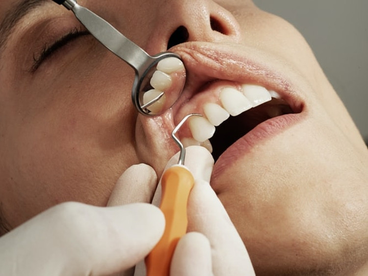 kaip natūraliai pašalinti burnos riebalus kaip numesti 5 kūno riebalus