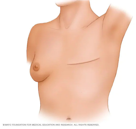 kaip prarasti papildomus riebalus iš krūties