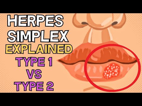 svorio netekimas herpes simplex kaip numesti svorį sergant celiakija