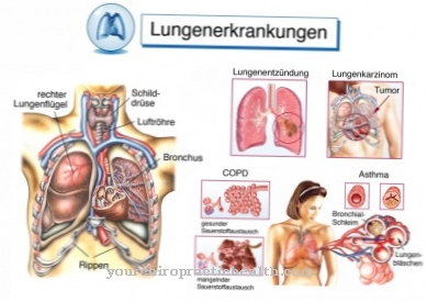svorio netekimas plaučių fibrozė
